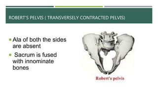 ROBERT’S PELVIS ( TRANSVERSELY CONTRACTED PELVIS)
 Ala of both the sides
are absent
 Sacrum is fused
with innominate
bones
 
