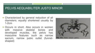 PELVIS AEQUABILITER JUSTO MINOR
 Characterized by general reduction of all
diameters; equally shortened usually by
1-2cm
 Occurs in short. Also occurs in women
with massive skeletal bones and
developed muscles, the pelvis has
masculine features such as narrow
sacrum, narrow pubic outlet (funnel-
shaped)
 