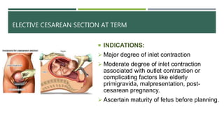 ELECTIVE CESAREAN SECTION AT TERM
 INDICATIONS:
 Major degree of inlet contraction
 Moderate degree of inlet contraction
associated with outlet contraction or
complicating factors like elderly
primigravida, malpresentation, post-
cesarean pregnancy.
 Ascertain maturity of fetus before planning.
 