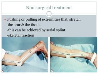 Scar Contracture Example Contracture managment.pptx