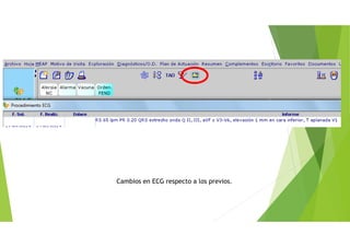 Cambios en ECG respecto a los previos.
 