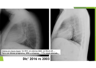 Dic’ 2016 vs 2003
Edema en cisura mayor. Sin RHY, sin edemas MMII, sin RA en AR....
Pero con disnea progresiva, DPN y ortopnea... Y Fx renal alterada...
 