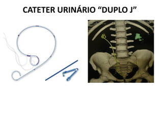 CATETER URINÁRIO “DUPLO J”
 
