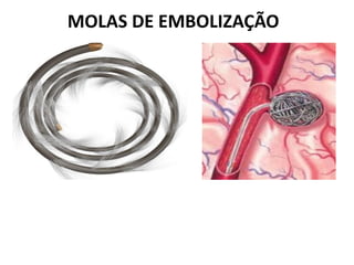 MOLAS DE EMBOLIZAÇÃO
 