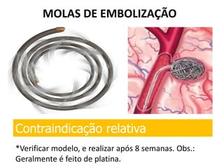 MOLAS DE EMBOLIZAÇÃO
*Verificar modelo, e realizar após 8 semanas. Obs.:
Geralmente é feito de platina.
Contraindicação relativa
 