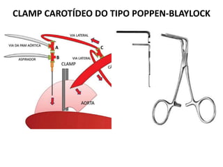 CLAMP CAROTÍDEO DO TIPO POPPEN-BLAYLOCK
 