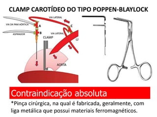 CLAMP CAROTÍDEO DO TIPO POPPEN-BLAYLOCK
Contraindicação absoluta
*Pinça cirúrgica, na qual é fabricada, geralmente, com
liga metálica que possui materiais ferromagnéticos.
 