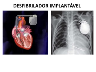 DESFIBRILADOR IMPLANTÁVEL
 