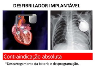 DESFIBRILADOR IMPLANTÁVEL
Contraindicação absoluta
*Descarregamento da bateria e desprogramação.
 