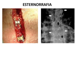 ESTERNORRAFIA
 