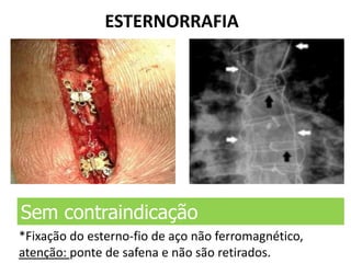 ESTERNORRAFIA
Sem contraindicação
*Fixação do esterno-fio de aço não ferromagnético,
atenção: ponte de safena e não são retirados.
 