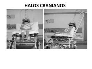 HALOS CRANIANOS
 