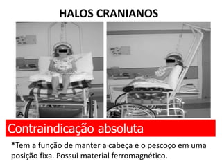 HALOS CRANIANOS
Contraindicação absoluta
*Tem a função de manter a cabeça e o pescoço em uma
posição fixa. Possui material ferromagnético.
 