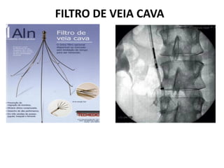 FILTRO DE VEIA CAVA
 