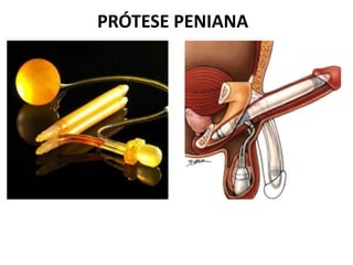 PRÓTESE PENIANA
 