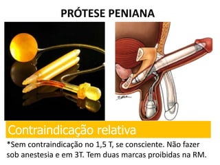 PRÓTESE PENIANA
Contraindicação relativa
*Sem contraindicação no 1,5 T, se consciente. Não fazer
sob anestesia e em 3T. Tem duas marcas proibidas na RM.
 