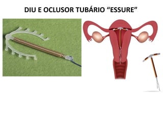 DIU E OCLUSOR TUBÁRIO “ESSURE”
 