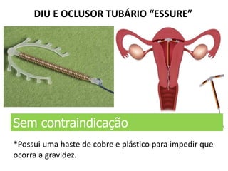 DIU E OCLUSOR TUBÁRIO “ESSURE”
Sem contraindicação
*Possui uma haste de cobre e plástico para impedir que
ocorra a gravidez.
 