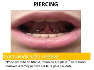 PIERCING
Contraindicação relativa
*Pode ser feito de titânio, teflon ou bio-plast. É necessário
remover, a remoção deve ser feita pelo paciente.
 