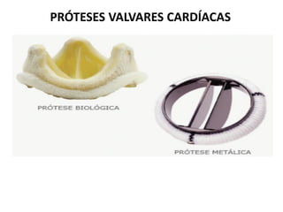 PRÓTESES VALVARES CARDÍACAS
 