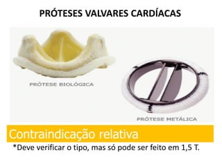 PRÓTESES VALVARES CARDÍACAS
Contraindicação relativa
*Deve verificar o tipo, mas só pode ser feito em 1,5 T.
 