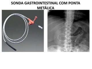 SONDA GASTROINTESTINAL COM PONTA
METÁLICA
 
