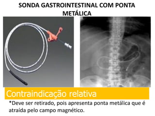SONDA GASTROINTESTINAL COM PONTA
METÁLICA
Contraindicação relativa
*Deve ser retirado, pois apresenta ponta metálica que é
atraída pelo campo magnético.
 