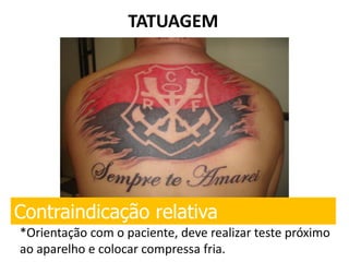TATUAGEM
Contraindicação relativa
*Orientação com o paciente, deve realizar teste próximo
ao aparelho e colocar compressa fria.
 