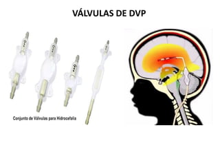 VÁLVULAS DE DVP
 