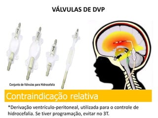 VÁLVULAS DE DVP
Contraindicação relativa
*Derivação ventrículo-peritoneal, utilizada para o controle de
hidrocefalia. Se tiver programação, evitar no 3T.
 