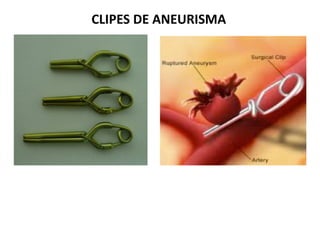 CLIPES DE ANEURISMA
 
