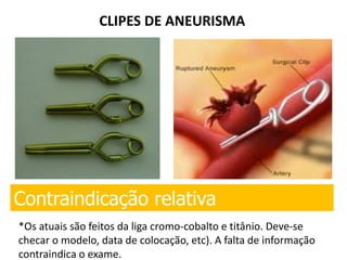 CLIPES DE ANEURISMA
Contraindicação relativa
*Os atuais são feitos da liga cromo-cobalto e titânio. Deve-se
checar o modelo, data de colocação, etc). A falta de informação
contraindica o exame.
 