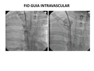 FIO GUIA INTRAVASCULAR
 