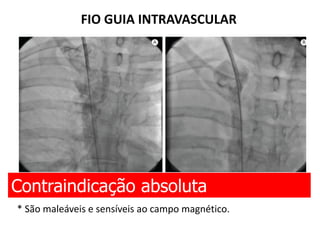 FIO GUIA INTRAVASCULAR
Contraindicação absoluta
* São maleáveis e sensíveis ao campo magnético.
 