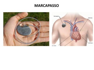 MARCAPASSO
 