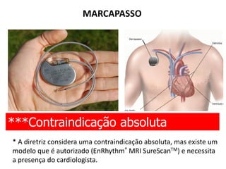 MARCAPASSO
***Contraindicação absoluta
* A diretriz considera uma contraindicação absoluta, mas existe um
modelo que é autorizado (EnRhythm® MRI SureScanTM) e necessita
a presença do cardiologista.
 