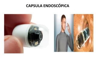 CAPSULA ENDOSCÓPICA
 