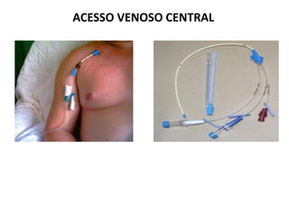ACESSO VENOSO CENTRAL
 