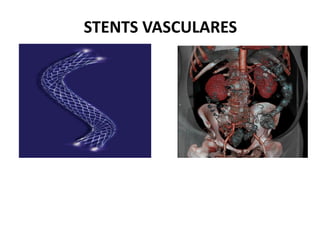 STENTS VASCULARES
 