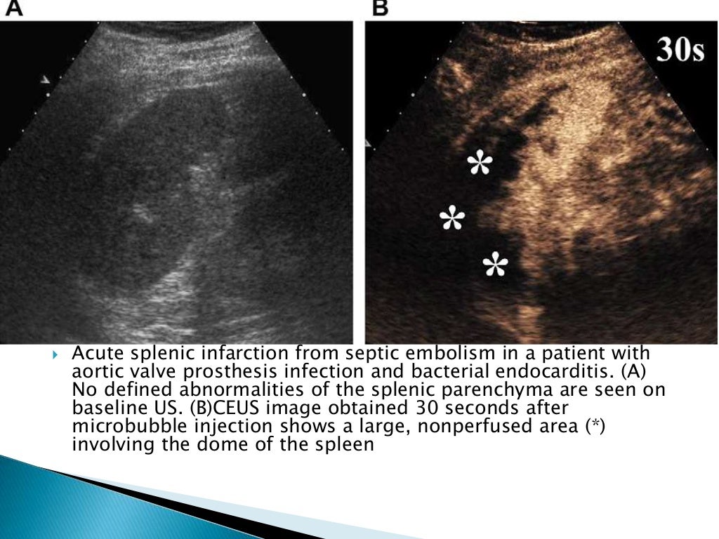 Contrast enhanced ultrasound