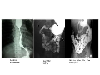 BARIUM
SWALLOW
BARIUM
MEAL
BARIUM MEAL FOLLOW
THROUGH
 
