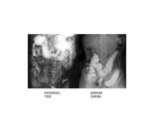 ENTEROCL
YSIS
BARIUM
ENEMA
 