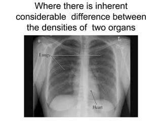 Where there is inherent
considerable difference between
the densities of two organs
 