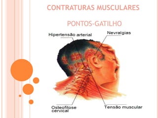 CONTRATURAS MUSCULARES PONTOS-GATILHO 