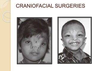 CRANIOFACIAL SURGERIES 
 
