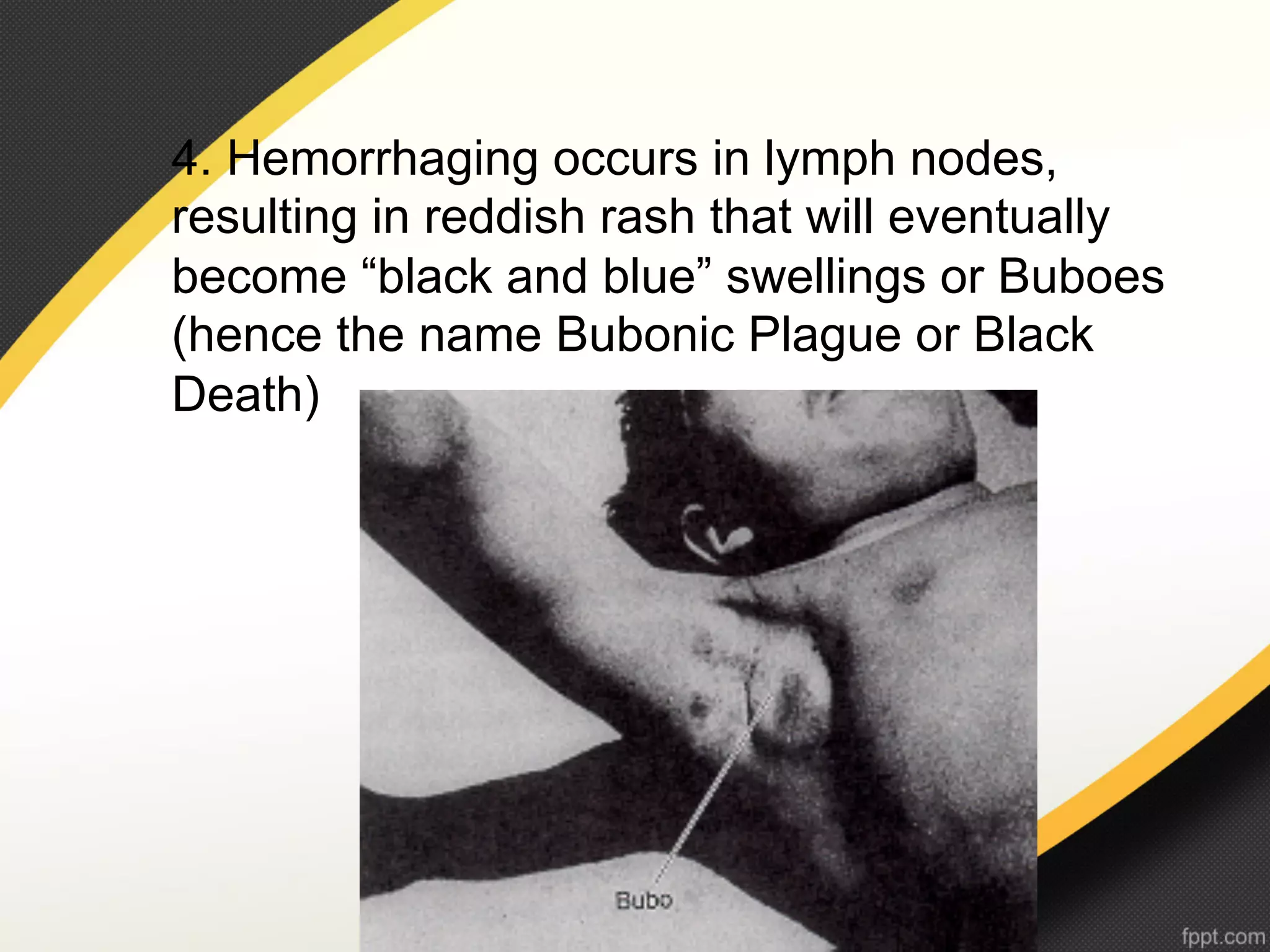 4. Hemorrhaging occurs in lymph nodes,
resulting in reddish rash that will eventually
become “black and blue” swellings or Buboes
(hence the name Bubonic Plague or Black
Death)
 