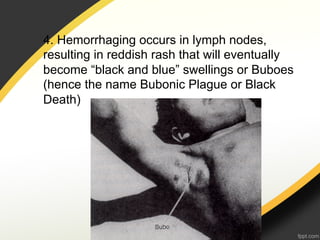 4. Hemorrhaging occurs in lymph nodes,
resulting in reddish rash that will eventually
become “black and blue” swellings or Buboes
(hence the name Bubonic Plague or Black
Death)
 