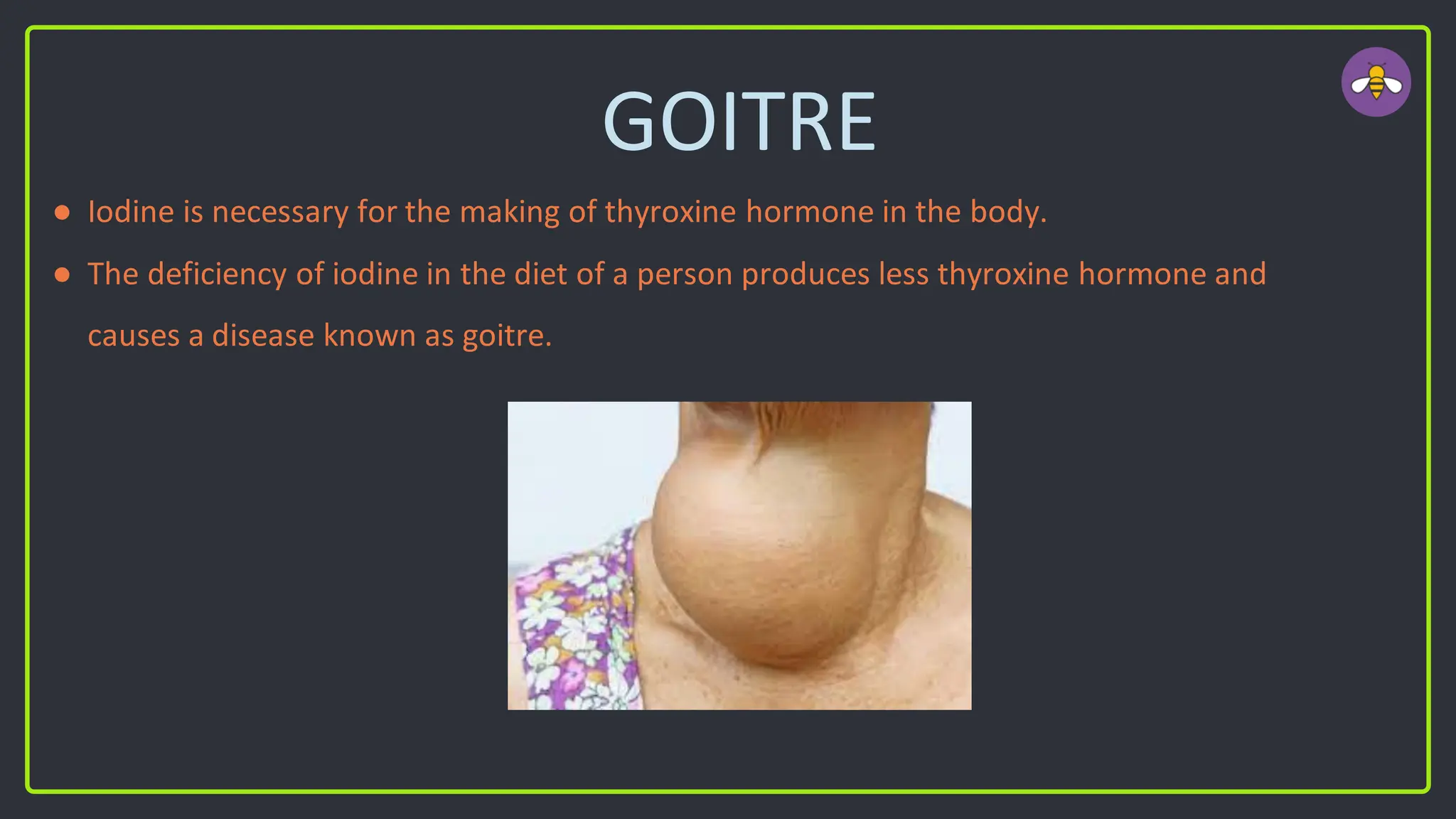 GOITRE
● Iodine is necessary for the making of thyroxine hormone in the body.
● The deficiency of iodine in the diet of a person produces less thyroxine hormone and
causes a disease known as goitre.
 