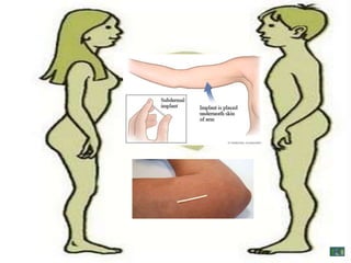 Control birth
