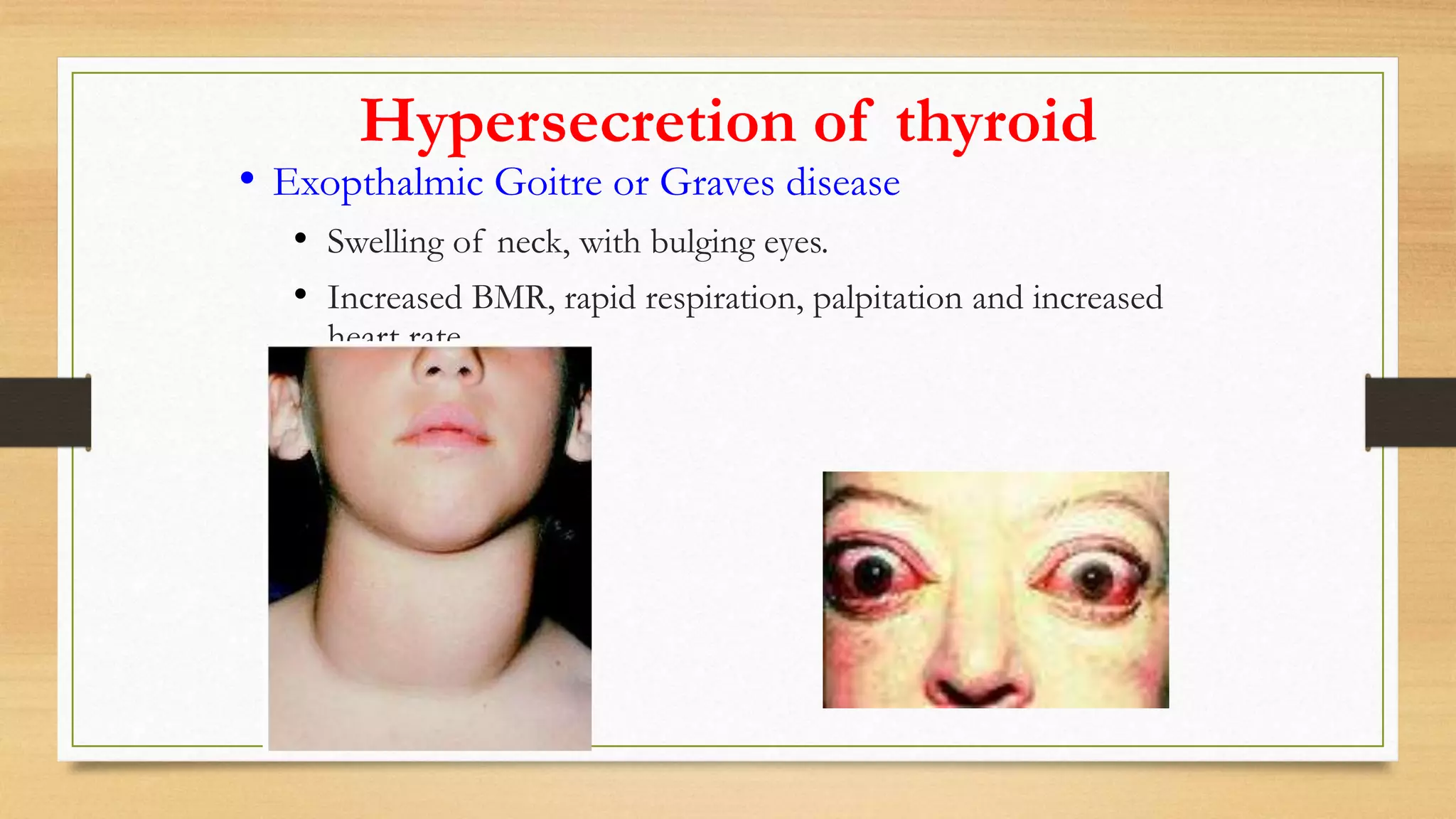 Hypersecretion of thyroid
• Exopthalmic Goitre or Graves disease
• Swelling of neck, with bulging eyes.
• Increased BMR, rapid respiration, palpitation and increased
heart rate.
 